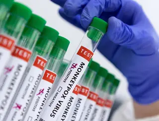 Secretaria da Saúde confirma segundo caso de varíola dos macacos em Curitiba