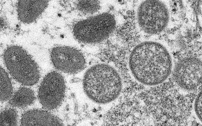 Roche diz que agiliza processo para trazer teste de varíola dos macacos ao Brasil